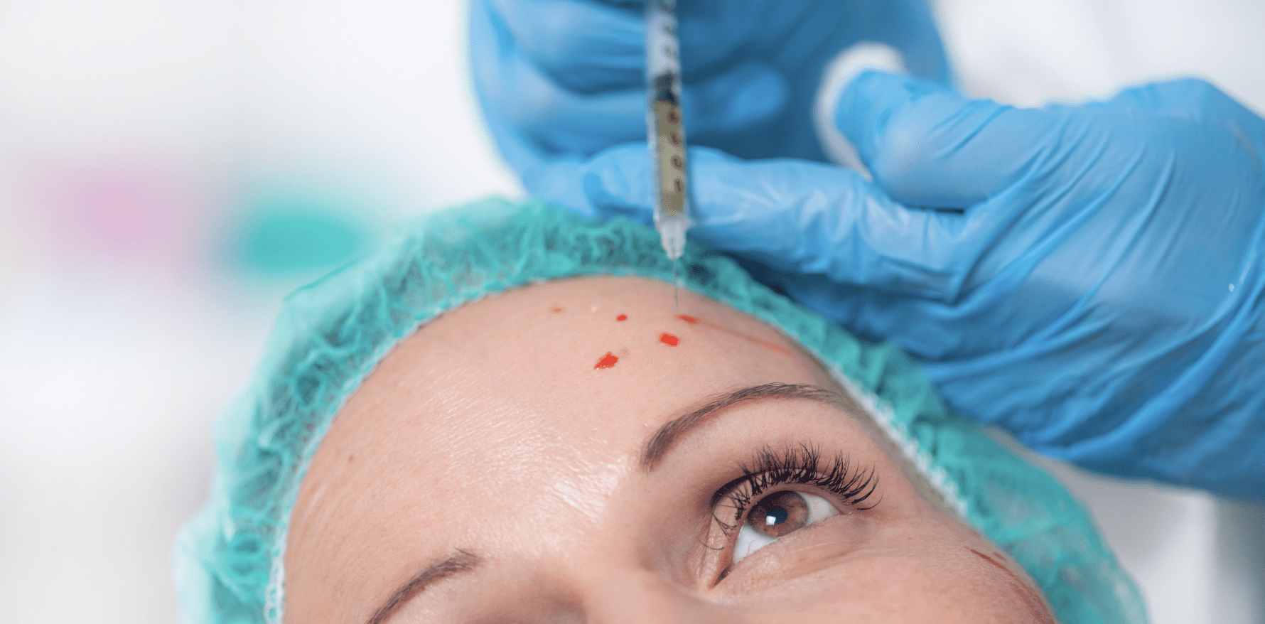 PRF With Microneedling The Feisee Institute