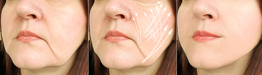 Non Surgical Facelift The Feisee Institute