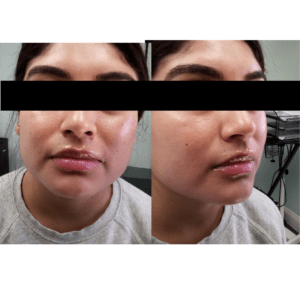 Lip Fillers Vienna  Lip Injections Tysons Corner