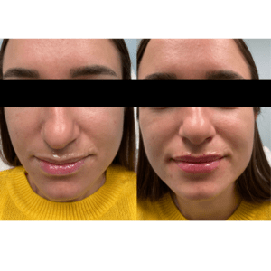 Lip Filler Before and After