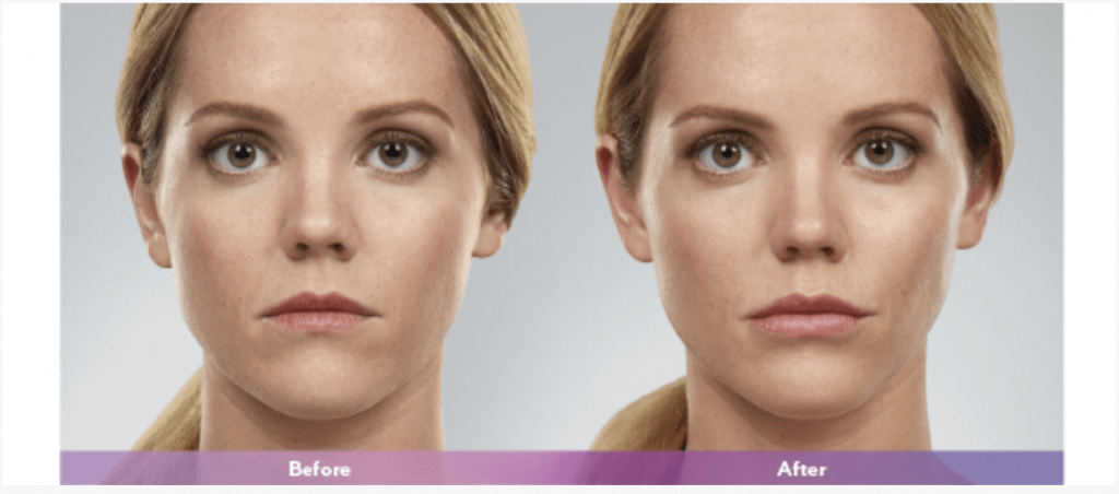 Juvederm Voluma