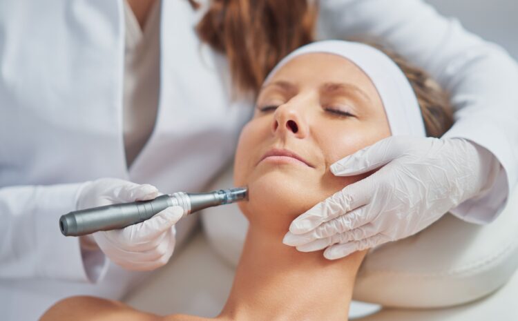 Microneedling for Acne in Vienna