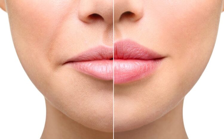  Enhance Your Natural Beauty with Dermal Fillers at The Feisee Institute