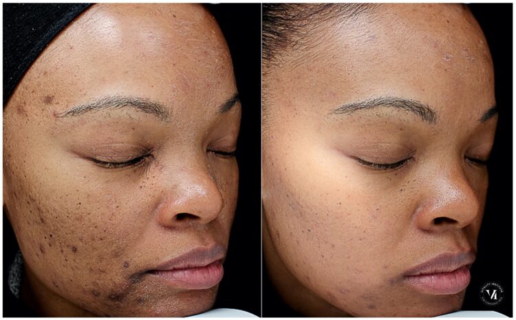 Reveal Radiant Skin with a VI Peel: Everything You Need to Know!