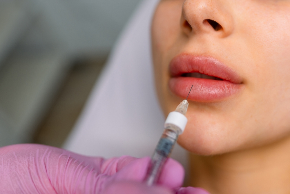 Affordable Lip Filler Injections in Vienna, Virginia
